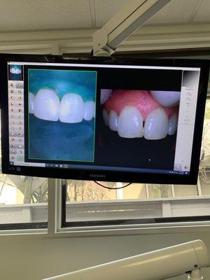 The right is before the filling and the left is after. What a difference!!!