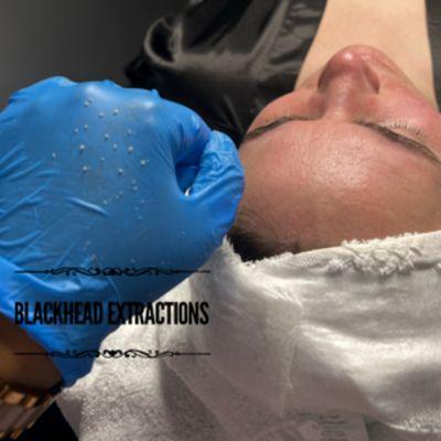 Blackhead extractions.