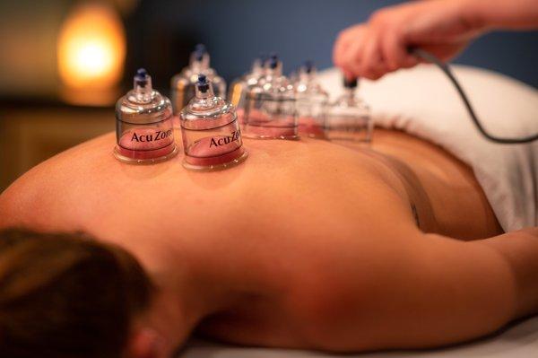 Cupping Therapy