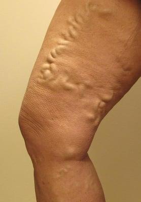 Before Venefit procedure.  Treatment for varicose veins.