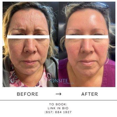 Botox, client received 50 units of Jeuveau