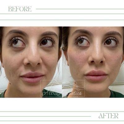 Our beautiful client came in to get a little filler on her cheeks , we used Restylane Contour to give her a natural lift.