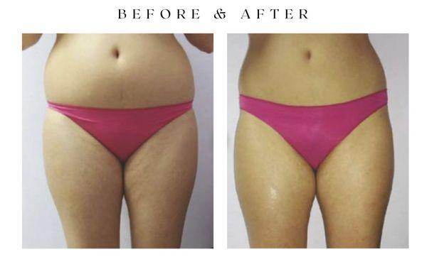 SLIM & TONE Body wrap, 8 treatments