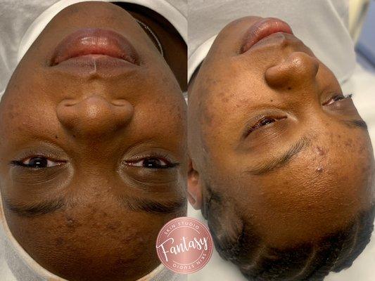 Before & After of our lovely client who received theglow facial treatment.