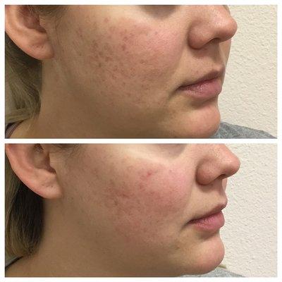 Before and after 3 microneedling treatments