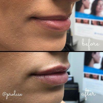 Volbella injectable for adding volume to lips