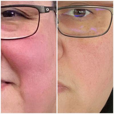 Rosacea Facial after one treatment