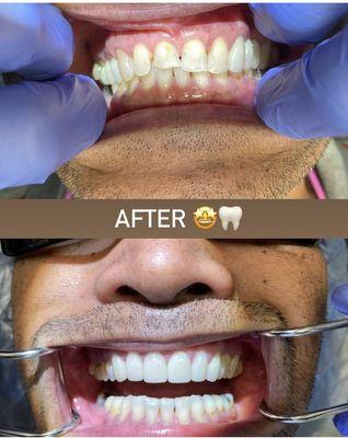 All new upper anterior crowns! Obsessed with this transformation on one of our patients!