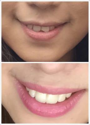 My teeth look so pretty now with affordable price. Thank you!