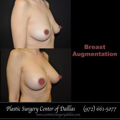 Breast Augmentation