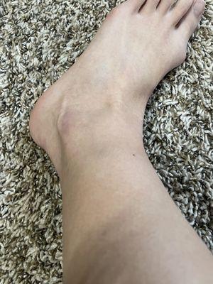 Left leg bruises on ankle & above ankle