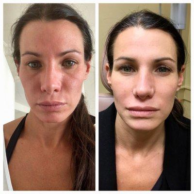 Restylane, great product