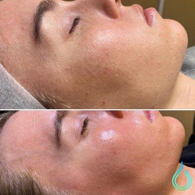 HydraFacial  -- the best facial of your life, in just 30min!