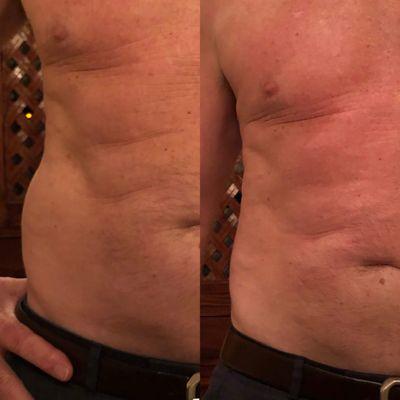 More before/after photos showing how we can reduce those Love Handles!