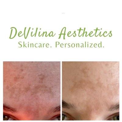 Melasma