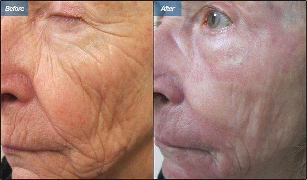 [Lasers (Anti-Wrinkle)] - Fine lines and wrinkles can dramatically improve with a single laser resurfacing treatment. DermLA.com