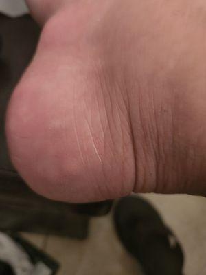 Wtffh?.. I got freaking blisters on my heel????