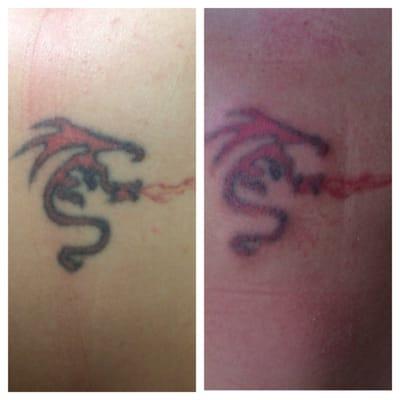 First treatment: Before and after.