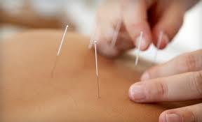 Acupuncture