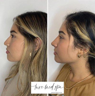 Non-Surgical Rhinoplasty (Nose Job) in Orlando, FL