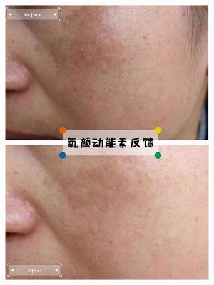 Melasma pigmentation treatment before and after