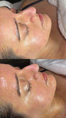 Signature Hydrafacial