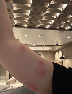 Bed Bug Bites on my arms from NCL Encore