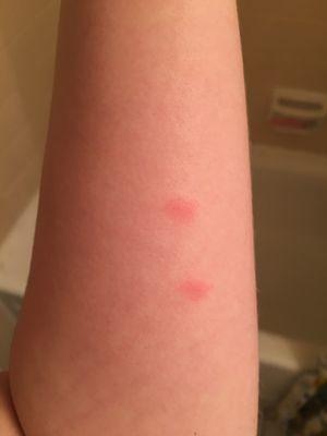 Bed bug bites :( had terrible sleep for most of the year.