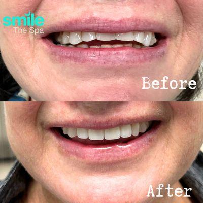 Before vs, After Veneers. 
Smile The Spa - Long Beach (CA) 
The Best Cosmetic Dentistry in California