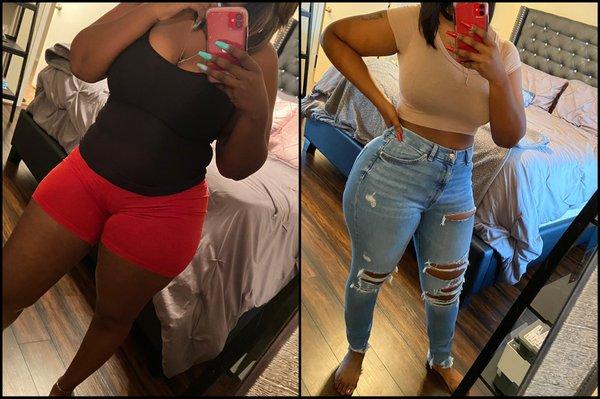 Snatched waist after 360 lipo!!