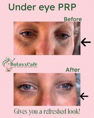 Under eye PRP for a refreshed look