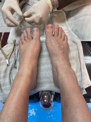 Ingrown toenail removal