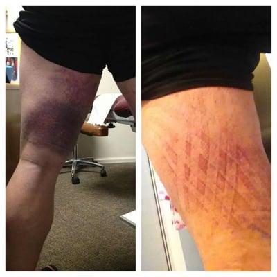 K Tape in action!  Before and after (3 days) photo of an application that is designed to facilitate lymphatic drainage.