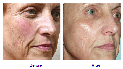 IPL Results - Intense Pulsed Light