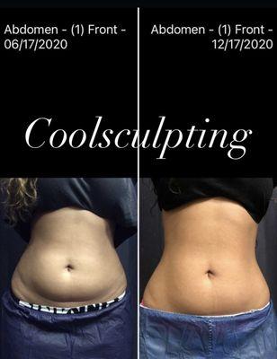 3 treatments Coolsculpting, along with proper diet and exercise.