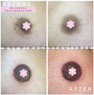 Areola Repigmentation