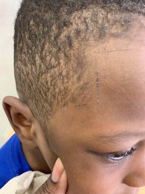 Scratched hair line