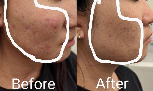 Scarlet Laser treatment for acne scar, enlarged pore, and smooth skin texture.