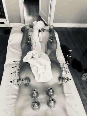 Cupping session hips & lower back.