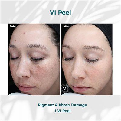 VI Peel treatment