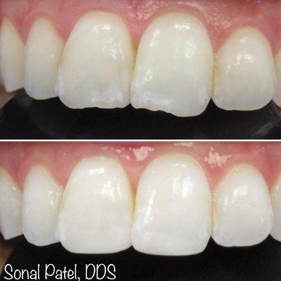 Chipped teeth- quick in-office solution in 45 minutes!