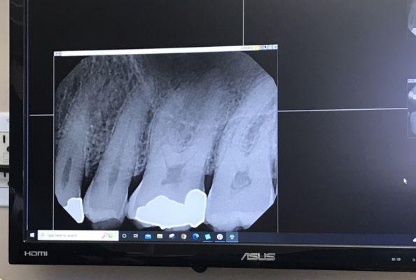 Digital X-ray. Instant display