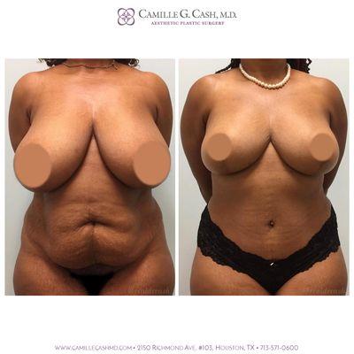 Before and After Mommy Makeover (Breast reduction, liposuction, and tummy tuck)