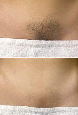 Before and After 10 minute Brazilian Wax
All hair is taken off from front to back