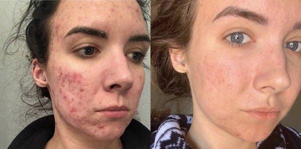 Acne transformation