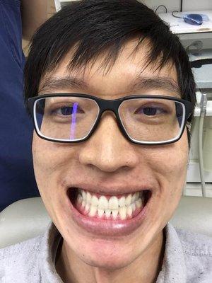 After 1 hour of the process, my teeth got brighter! Dr. Lee says this will usually last for a few years. Very cost effective for only $200!