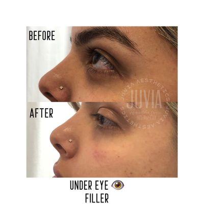 Under eye fillers..