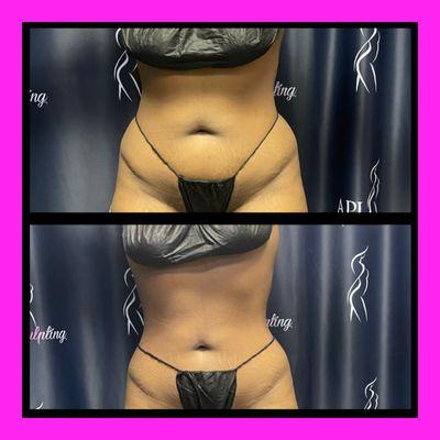 3 sessions of Laser Lipo