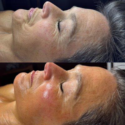 Dermaplane + Age management