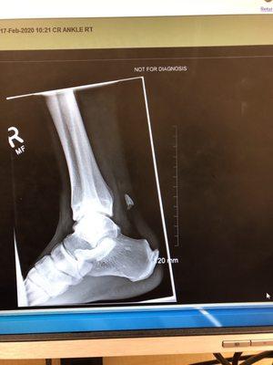 Calcaneus Avulsion Rupture of the Achilles